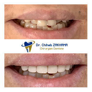 Couronnes en Zircone