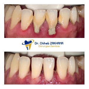 Détartrage et Polissage Complet
