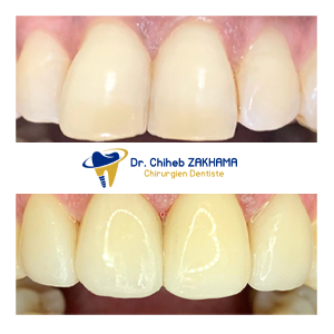 Facettes en Céramique