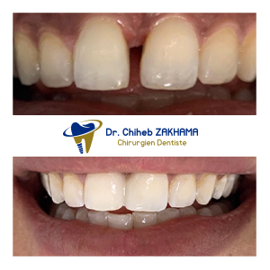 Fermeture de diastème en une séance