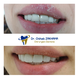 Remplacement de Couronnes en couronnes en Zircone Ceramique