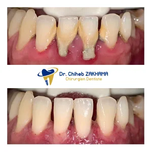 تبييض الأسنان