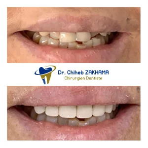 تيجان زركونيا