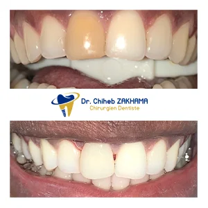 جسر زركونيا