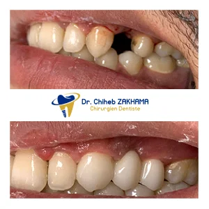 سيراميك فينيرز