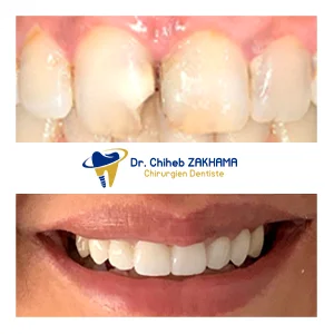 علاج اللثة إزالة الكلف