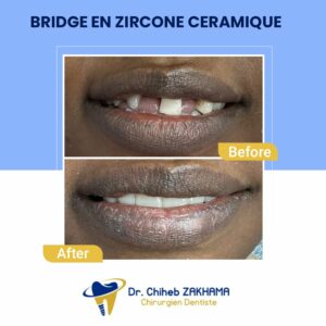 Bridge-Zircone-Ceramique