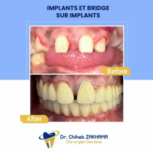 Implants-Bridge