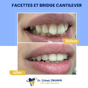 facettes-bridge cantilever