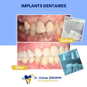 implants-dentaires