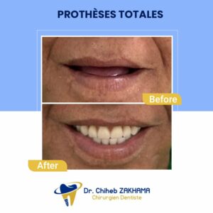 prothèses-totales